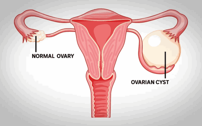 Symptoms of Ovarian Cancer That Often Go Unnoticed
